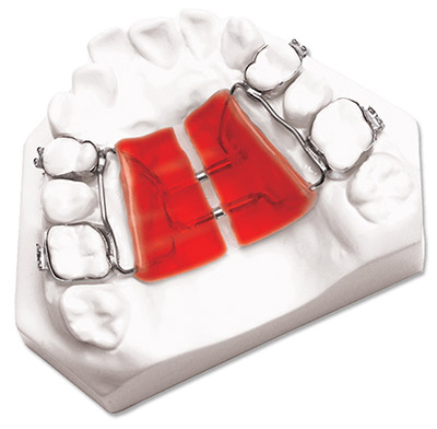 palatal expander for crossbite