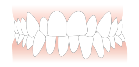 open bite example