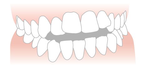 open bite example