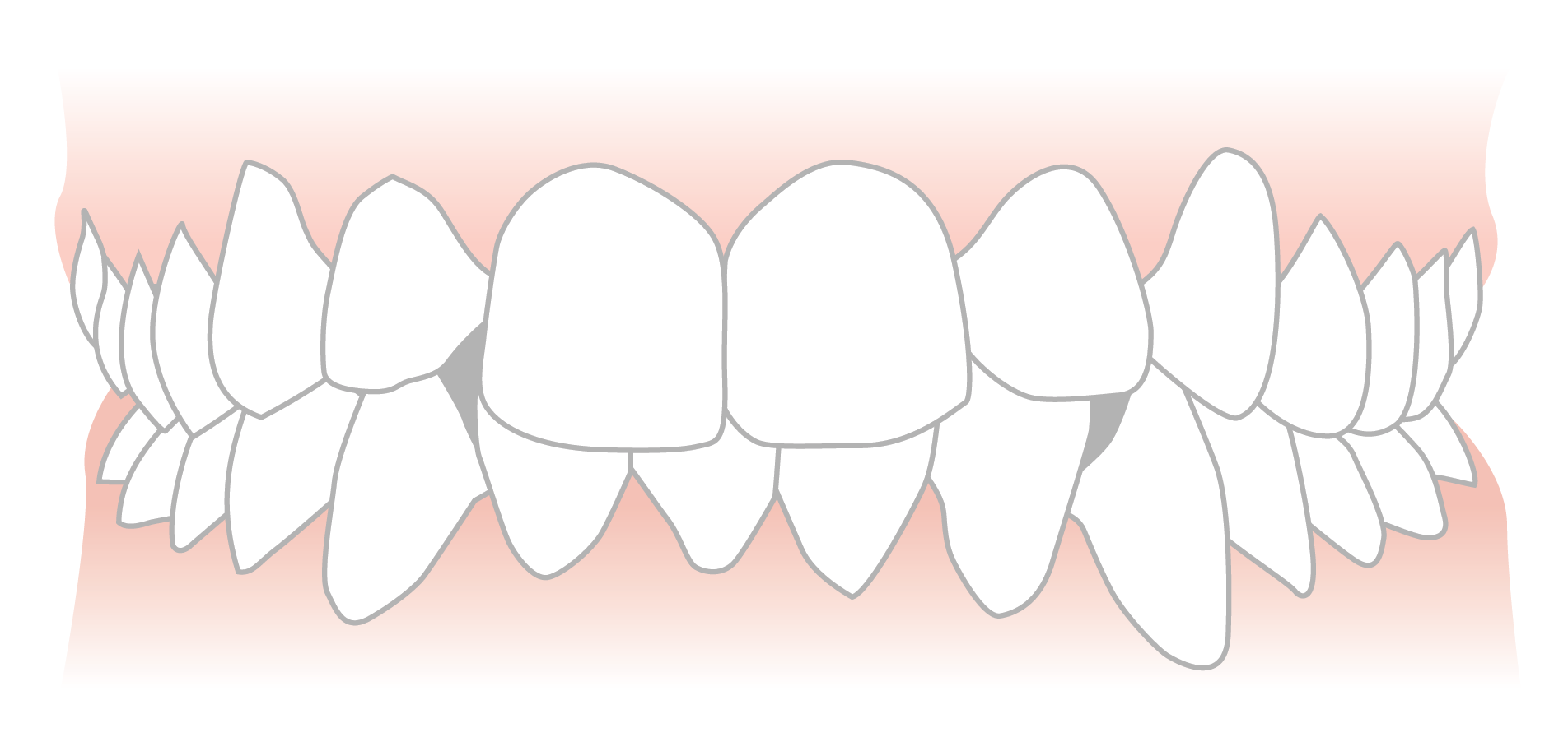 overbite and crooked teeth