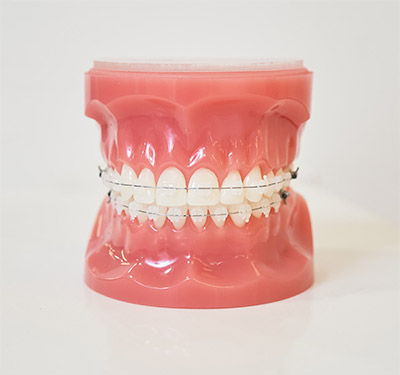 clear ceramic braces