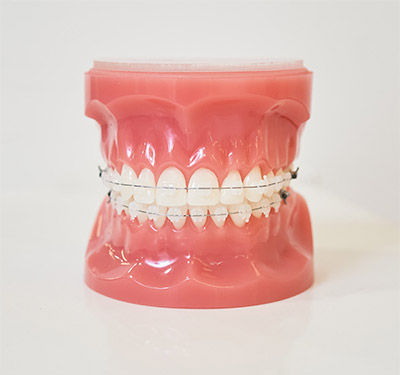 Ceramic Braces - Best Orthodontist NYC