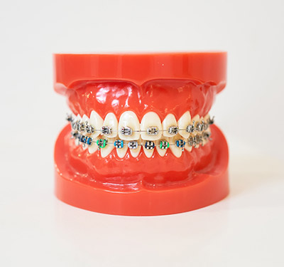 Dental Braces NYC (Ceramic, Clear)