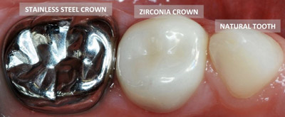 white vs silver crowns